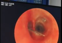 EHU d’Oran : Extraction d’une épingle des poumons d’une adolescente